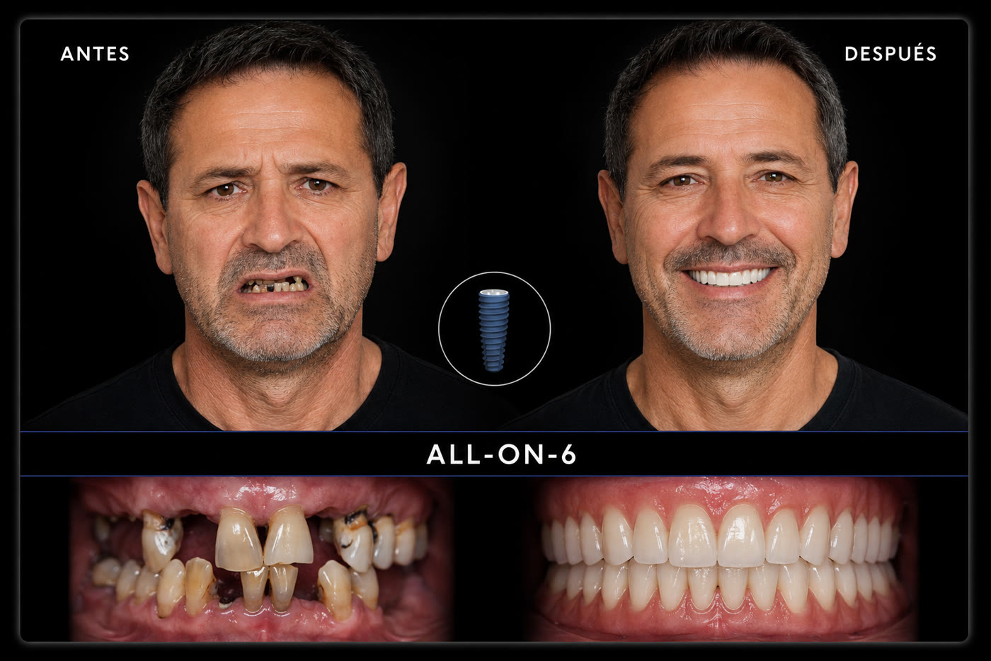 Antes y después — All-on-6